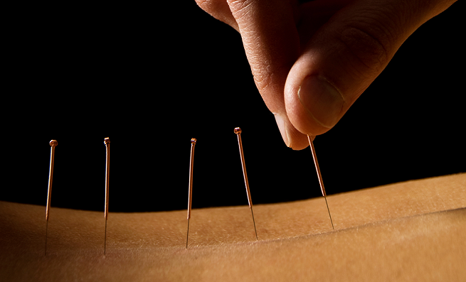 Akupunktūros procedūra